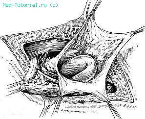 От чего выходит грыжа мочевого пузыря thumbnail